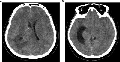 Trigone ventricular glioblastoma multiforme with trapped temporal horn: A case report